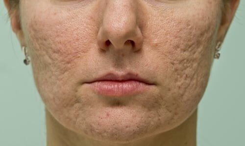 menopausal acne2 1