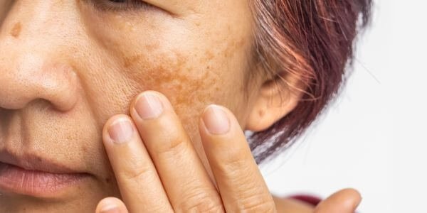 menopause itchy skin